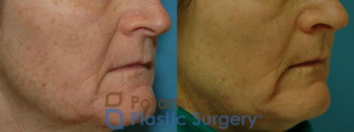 Before & After Skin Care Case 10 Right Oblique View in Washington, DC