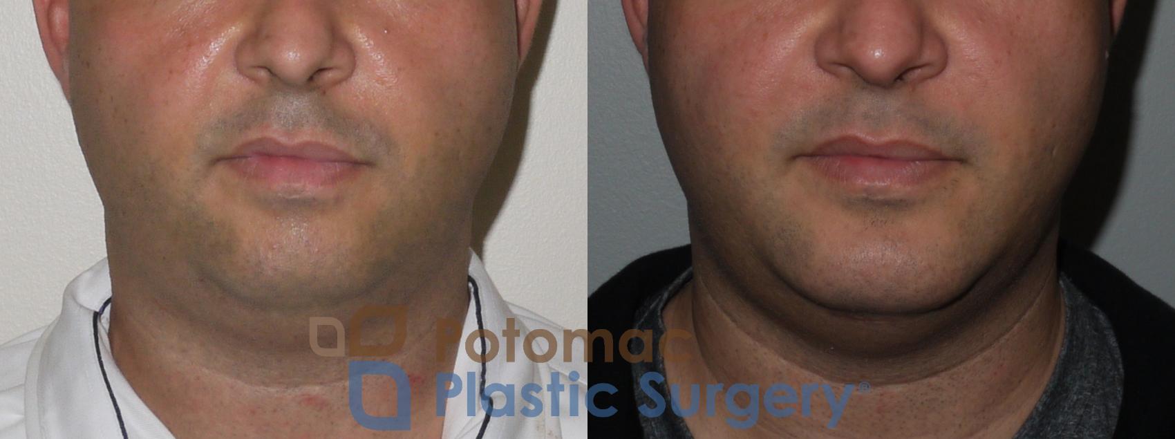 Before & After Chin Augmentation Case 111 Front View in Washington, DC
