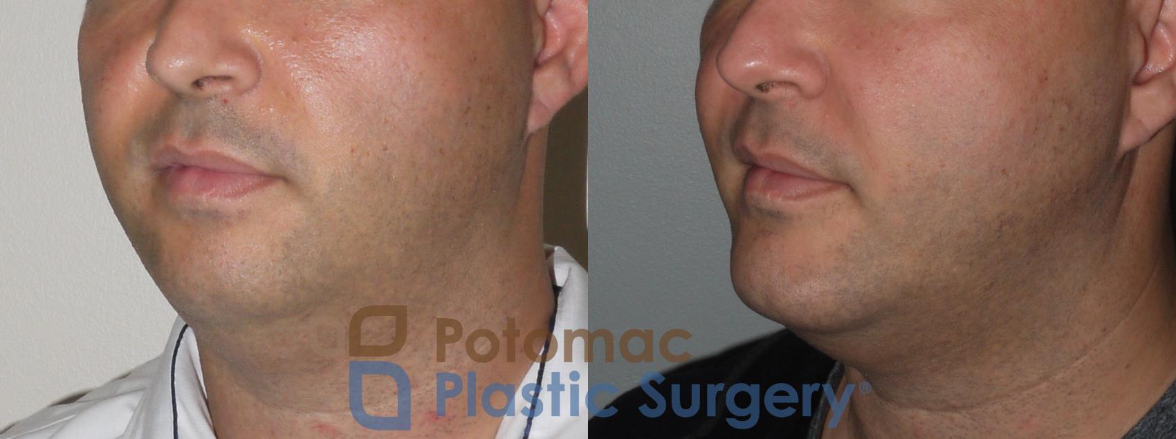 Before & After Chin Augmentation Case 111 Left Oblique View in Washington, DC
