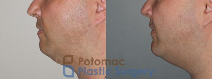 Before & After Facial Sculpting Case 111 Left Side View in Washington DC & Arlington , DC