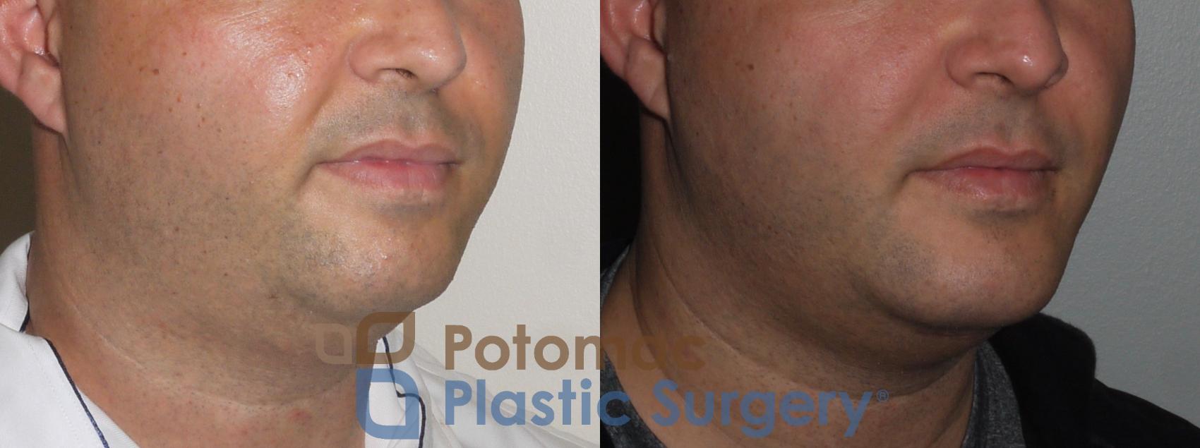 Before & After Chin Augmentation Case 111 Right Oblique View in Washington, DC