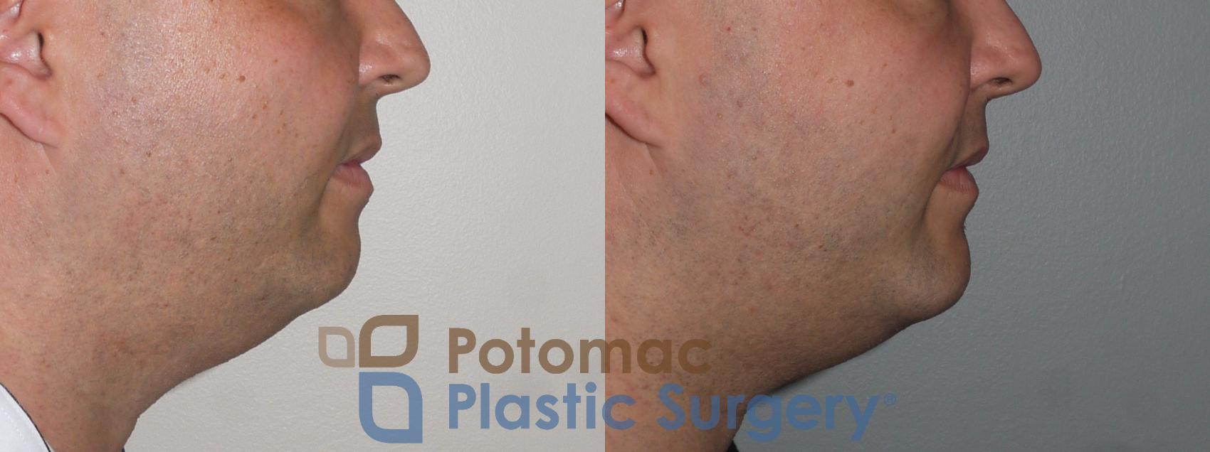 Before & After Chin Augmentation Case 111 Right Side View in Washington, DC