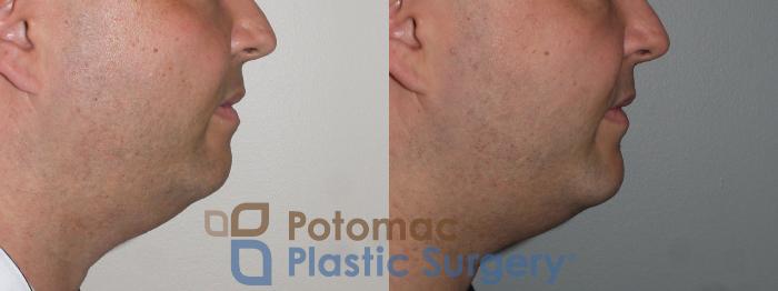 Before & After Facial Sculpting Case 111 Right Side View in Washington DC & Arlington , DC