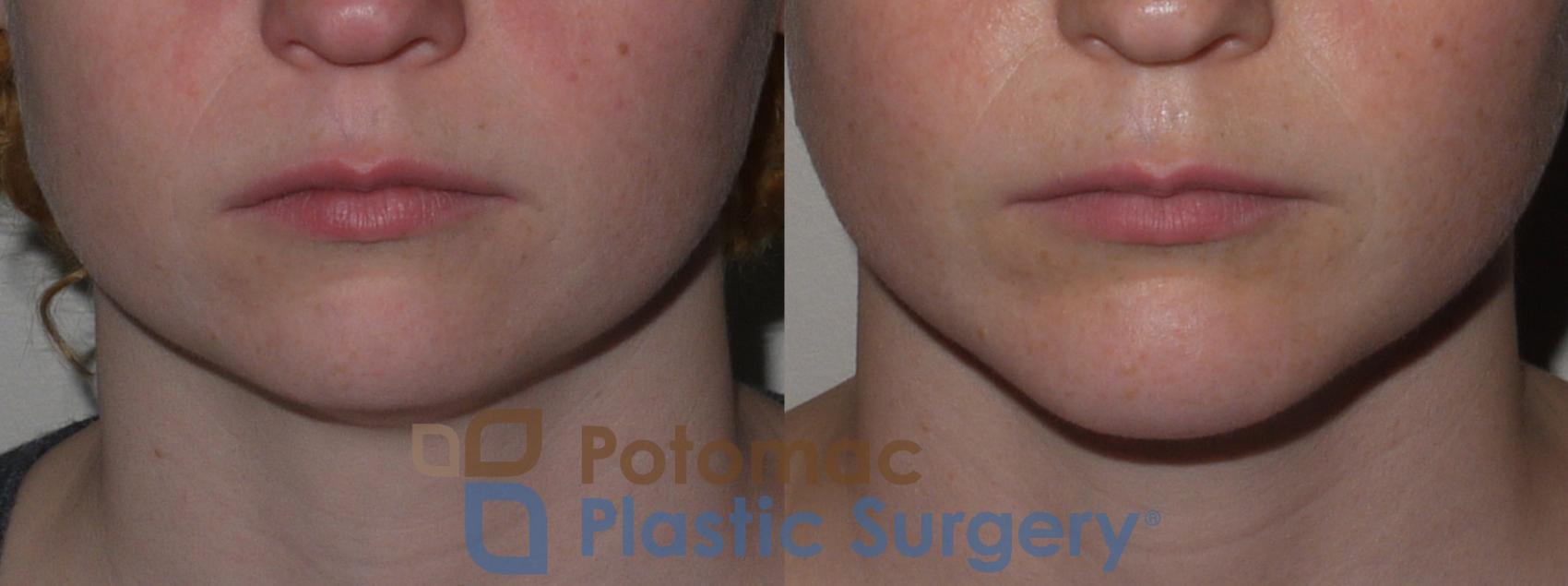 Before & After Chin Augmentation Case 121 Front View in Washington, DC