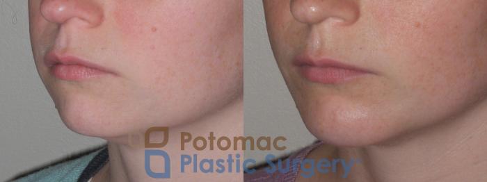 Before & After Chin Augmentation Case 121 Left Oblique View in Washington, DC