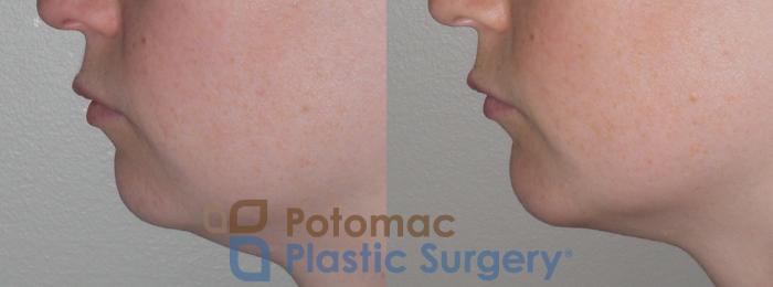 Before & After Chin Augmentation Case 121 Left Side View in Washington, DC