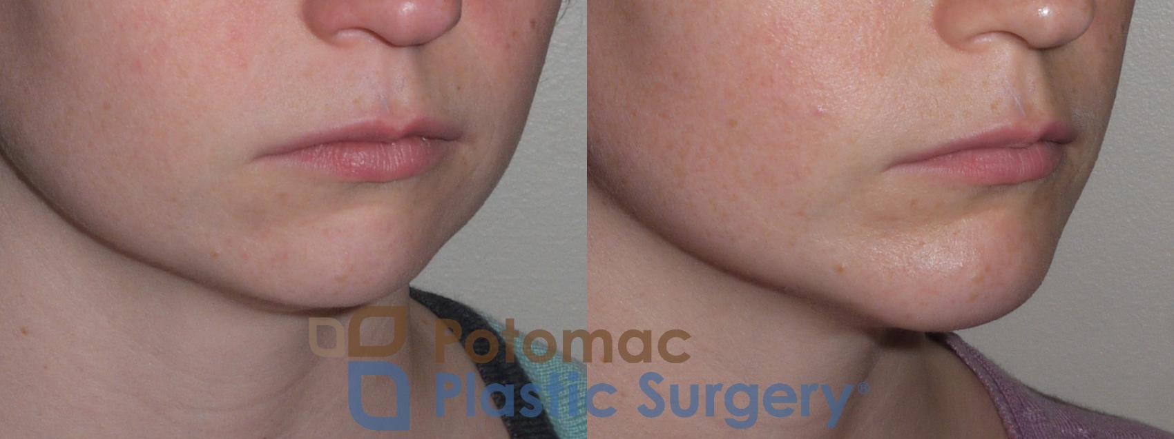 Before & After Chin Augmentation Case 121 Right Oblique View in Washington DC & Arlington , DC