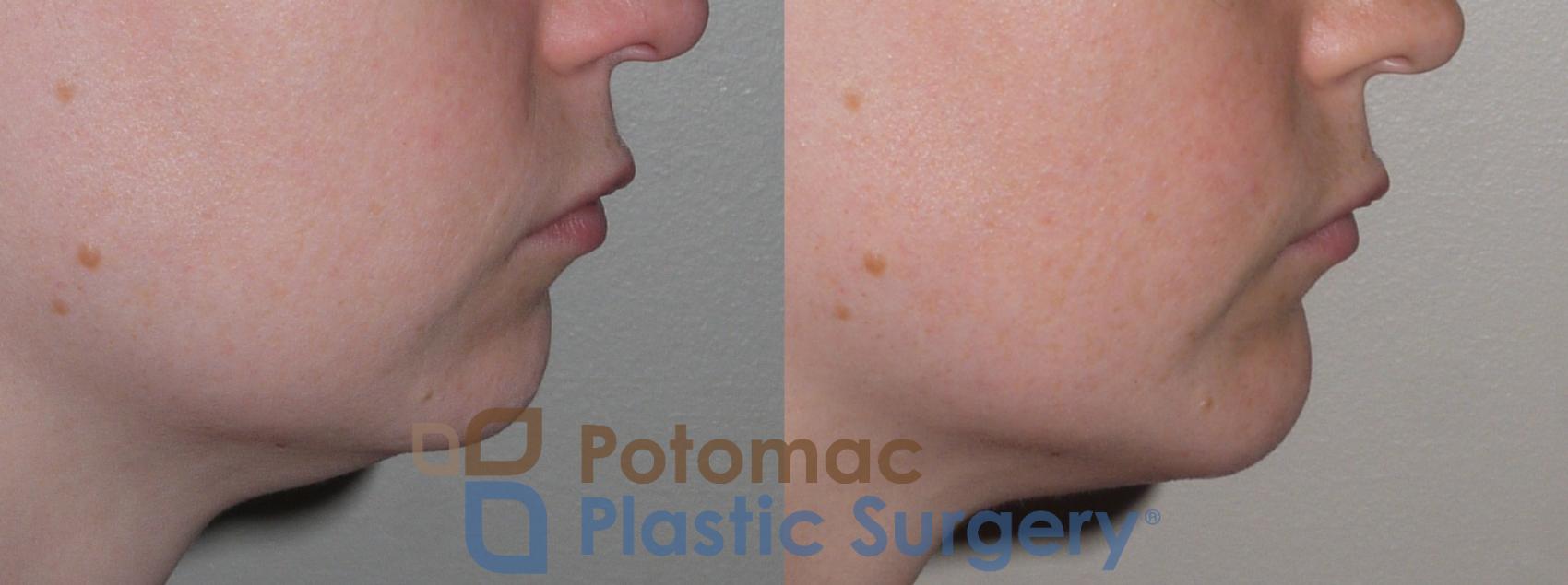 Before & After Chin Augmentation Case 121 Right Side View in Washington, DC