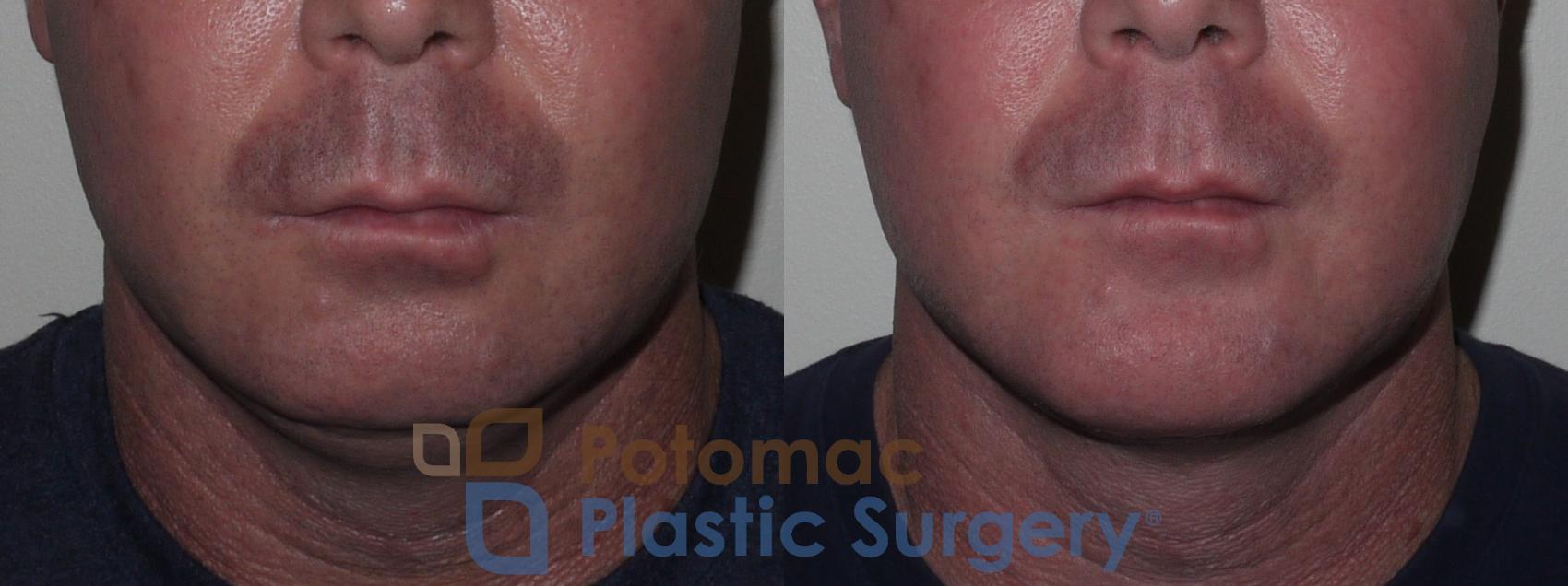 Before & After Chin Augmentation Case 133 Front View in Washington, DC