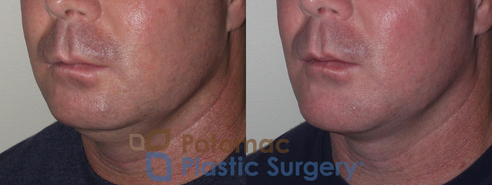 Before & After Chin Augmentation Case 133 Left Oblique View in Washington, DC