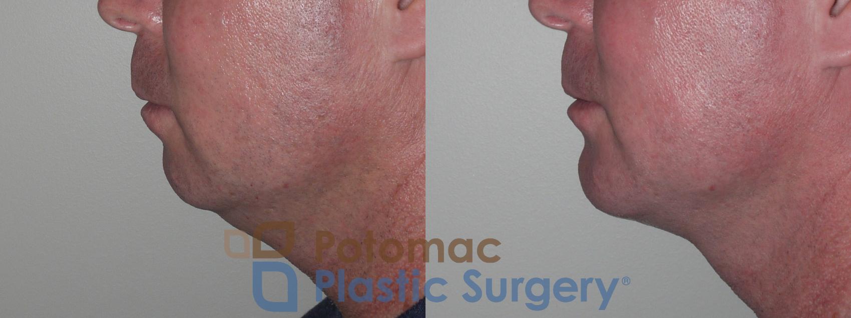 Before & After Facial Sculpting Case 133 Left Side View in Washington DC & Arlington , DC