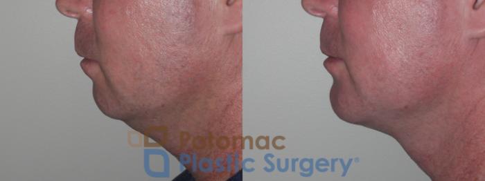 Before & After Liposuction Case 133 Left Side View in Washington DC & Arlington , DC