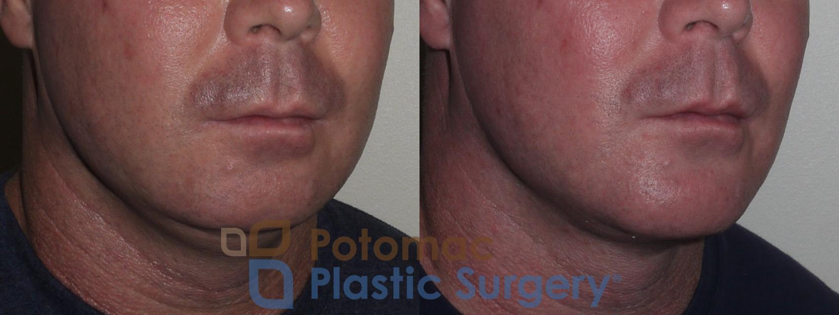 Before & After Chin Augmentation Case 133 Right Oblique View in Washington, DC