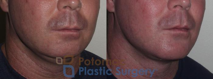 Before & After Chin Augmentation Case 133 Right Oblique View in Washington DC & Arlington , DC