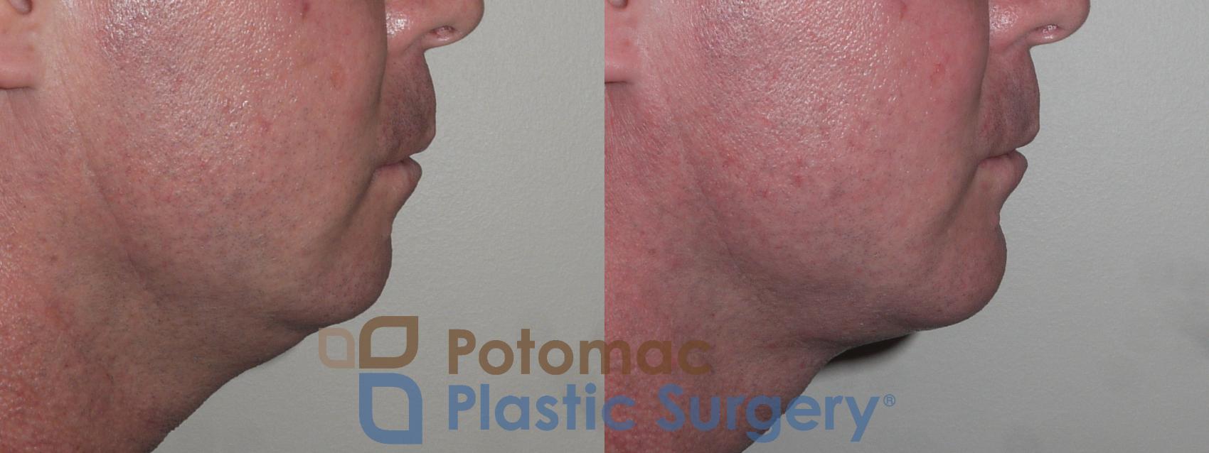 Before & After Chin Augmentation Case 133 Right Side View in Washington, DC