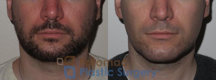 Before & After Chin Augmentation Case 137 Front View in Washington DC & Arlington , DC