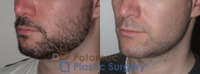 Before & After Chin Augmentation Case 137 Left Oblique View in Washington DC & Arlington , DC