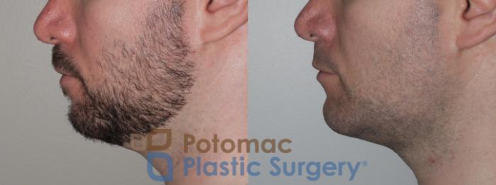 Before & After Chin Augmentation Case 137 Left Side View in Washington DC & Arlington , DC