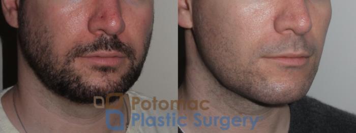 Before & After Facial Sculpting Case 137 Right Oblique View in Washington DC & Arlington , DC