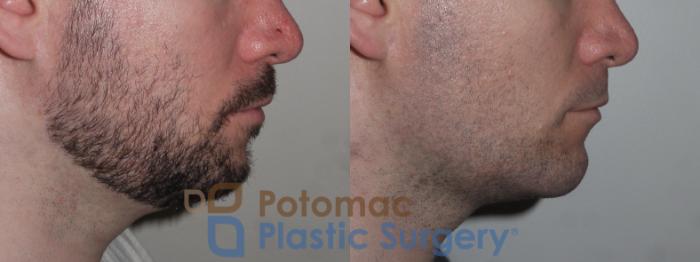 Before & After Facial Sculpting Case 137 Right Side View in Washington DC & Arlington , DC
