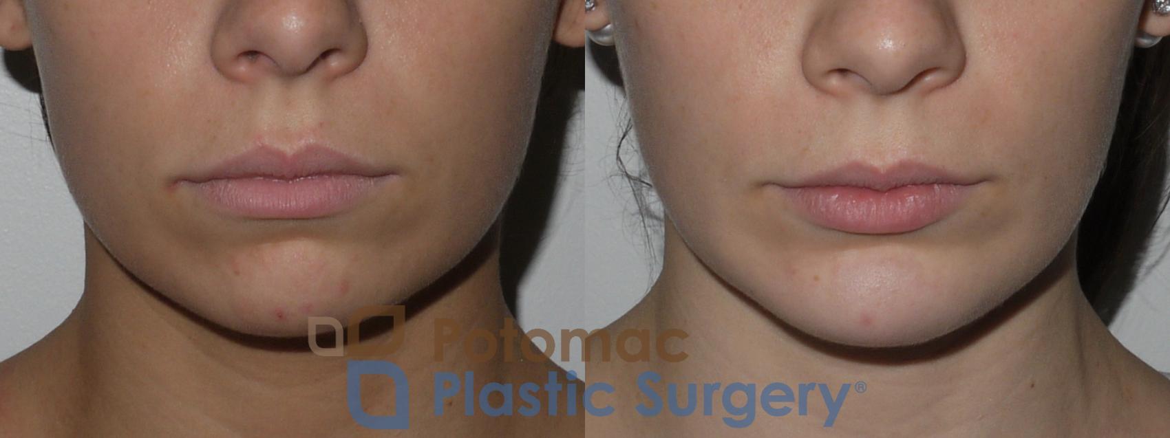 Before & After Chin Augmentation Case 140 Front View in Washington, DC
