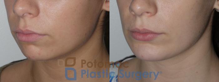 Before & After Chin Augmentation Case 140 Left Oblique View in Washington, DC