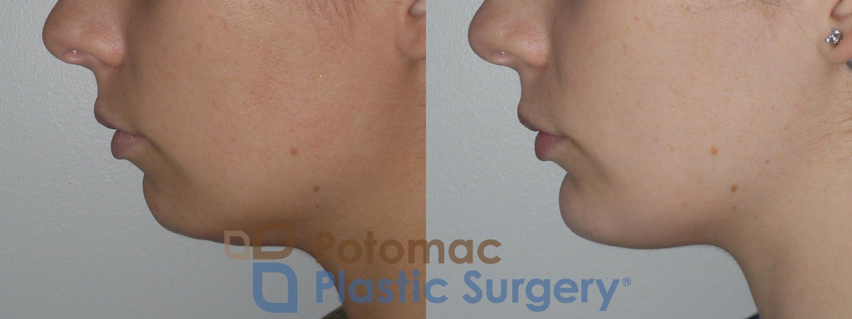 Before & After Chin Augmentation Case 140 Left Side View in Washington, DC