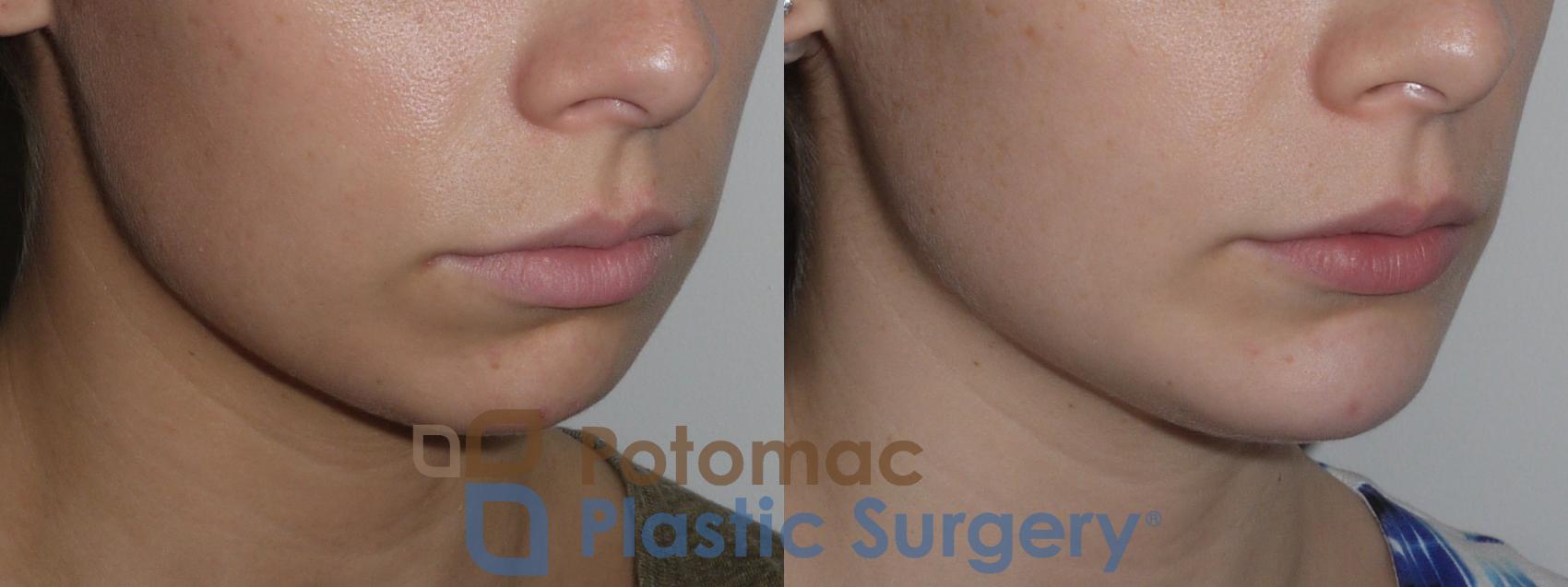 Before & After Chin Augmentation Case 140 Right Oblique View in Washington, DC