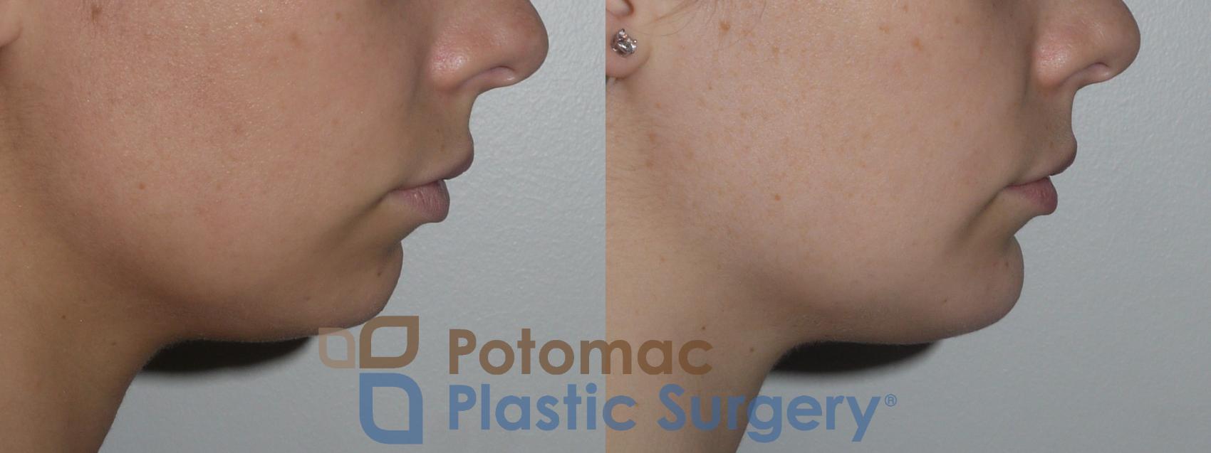 Before & After Chin Augmentation Case 140 Right Side View in Washington, DC