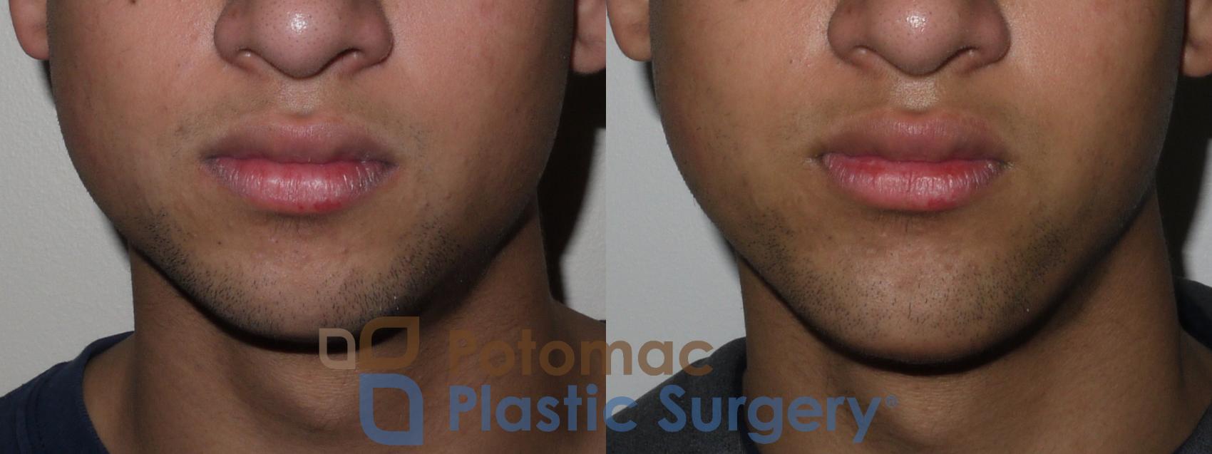 Before & After Facial Sculpting Case 144 Front View in Washington DC & Arlington , DC