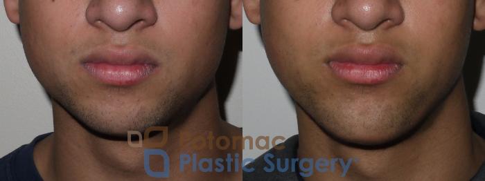 Before & After Chin Augmentation Case 144 Front View in Washington DC & Arlington , DC