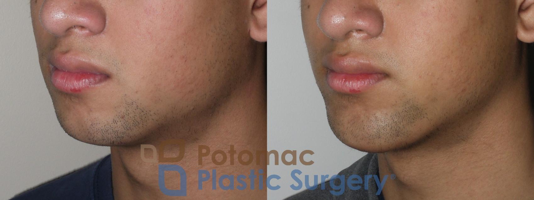 Before & After Chin Augmentation Case 144 Left Oblique View in Washington, DC