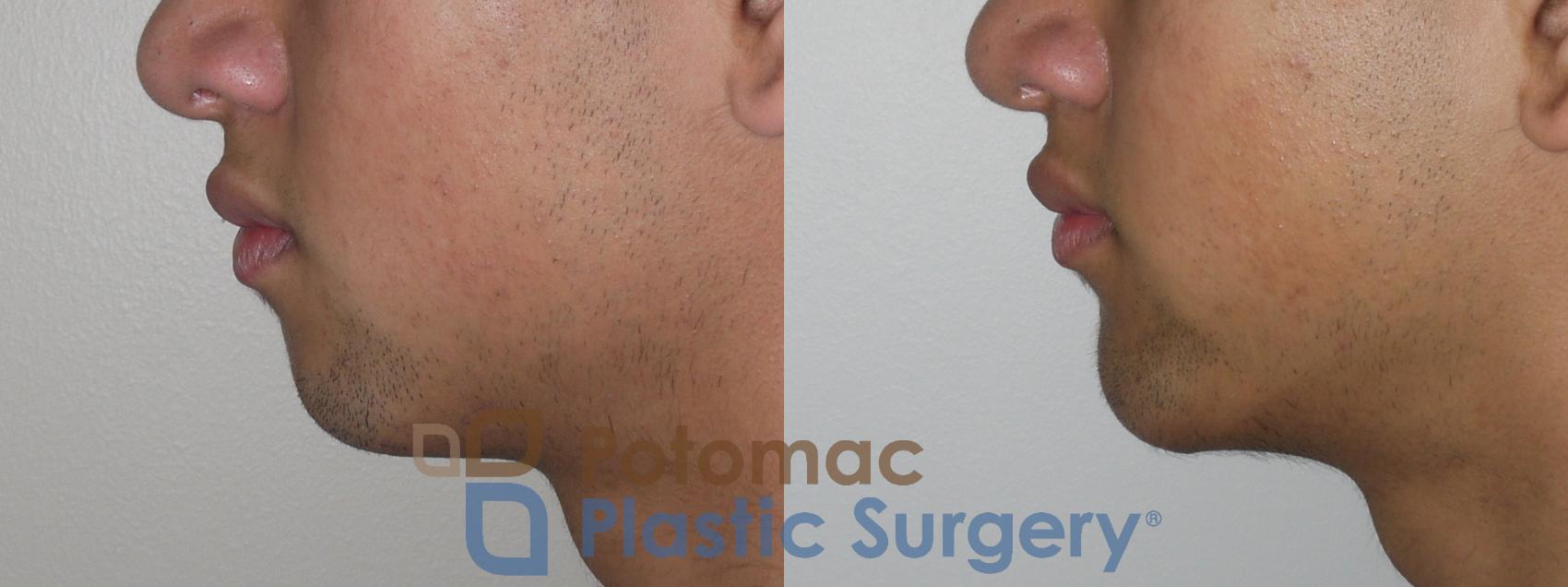 Before & After Chin Augmentation Case 144 Left Side View in Washington, DC