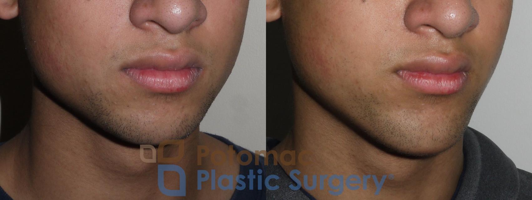 Before & After Chin Augmentation Case 144 Right Oblique View in Washington, DC