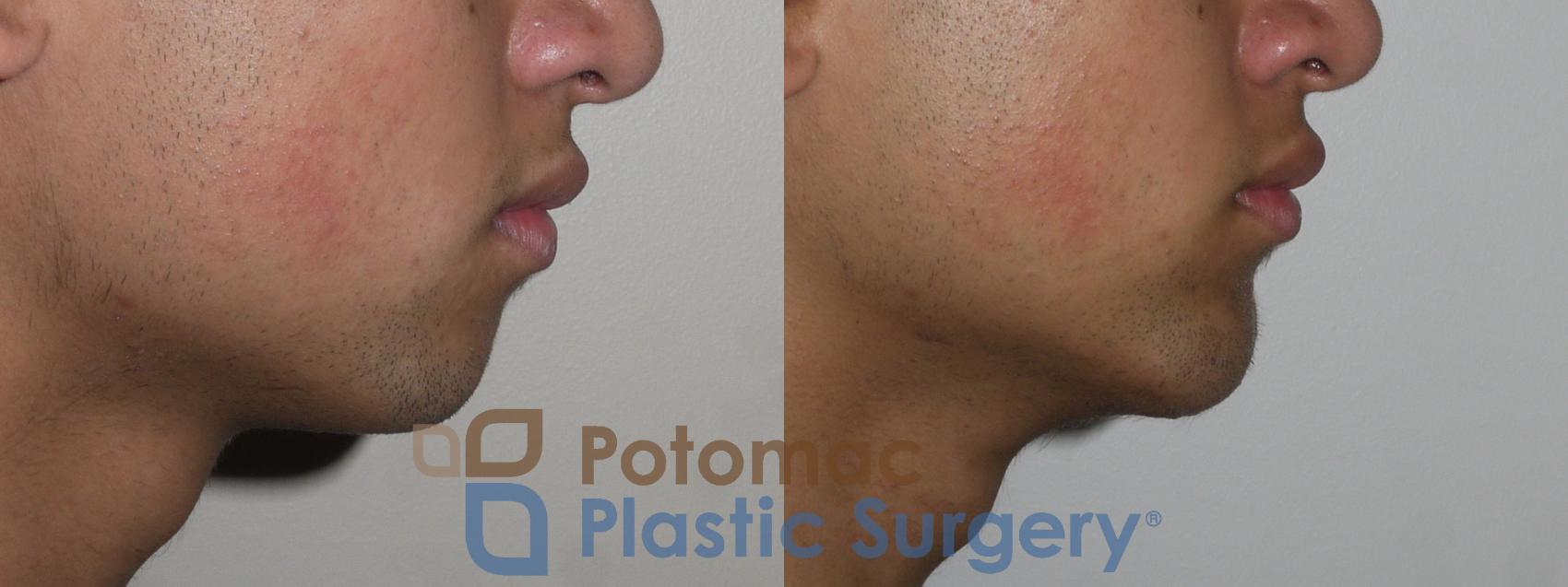 Before & After Chin Augmentation Case 144 Right Side View in Washington, DC