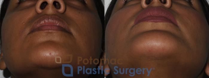 Before & After Chin Augmentation Case 167 Below View in Washington, DC