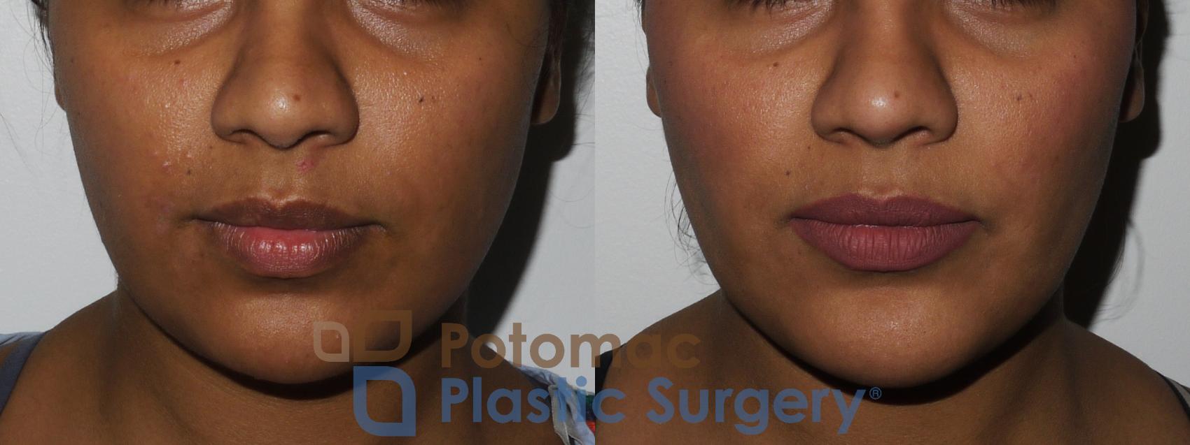 Before & After Buccal Fat Reduction Case 167 Front View in Washington, DC