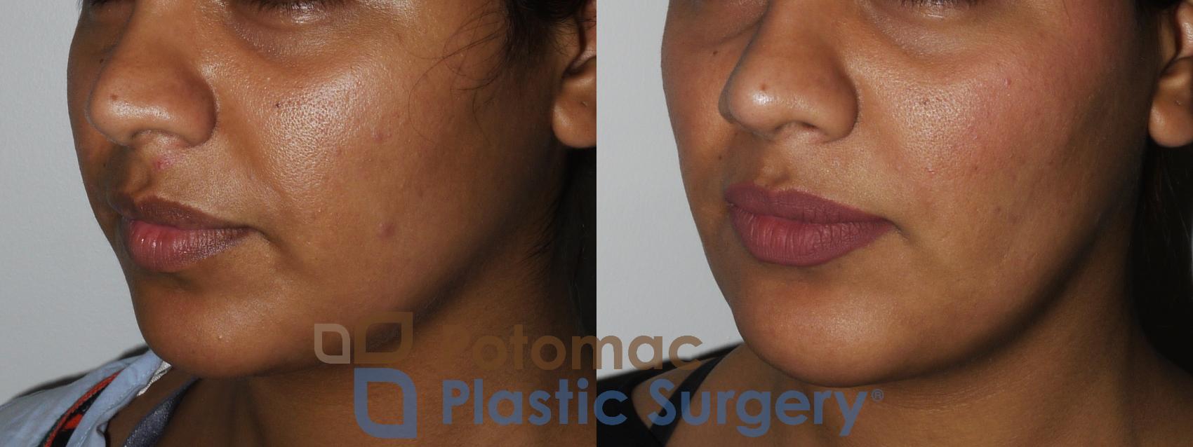 Before & After Facial Sculpting Case 167 Left Oblique View in Washington DC & Arlington , DC