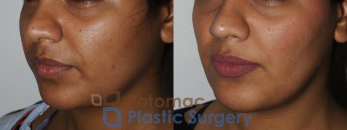 Before & After Chin Augmentation Case 167 Left Oblique View in Washington, DC