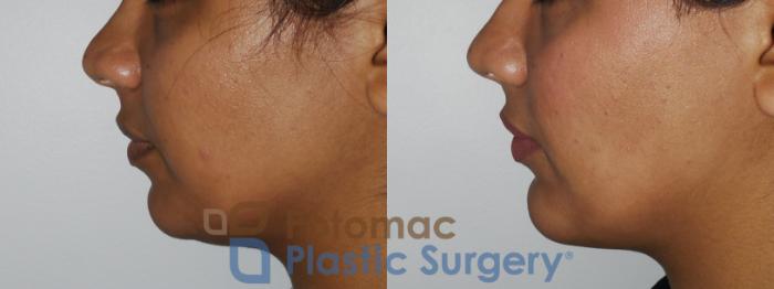 Before & After Chin Augmentation Case 167 Left Side View in Washington, DC