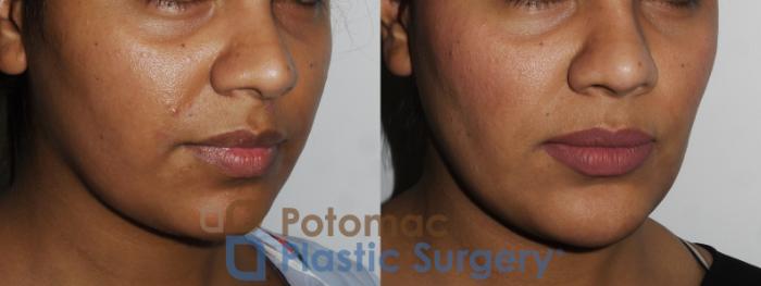 Before & After Chin Augmentation Case 167 Right Oblique View in Washington, DC