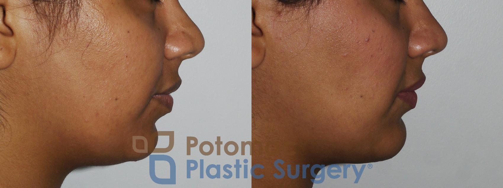 Before & After Chin Augmentation Case 167 Right Side View in Washington, DC