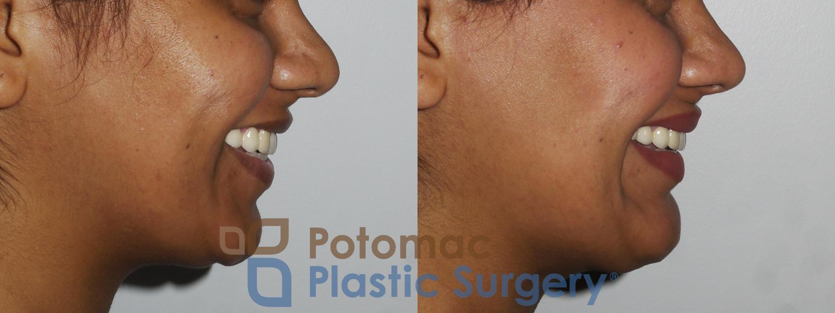 Before & After Chin Augmentation Case 167 Right Side View #2 View in Washington, DC