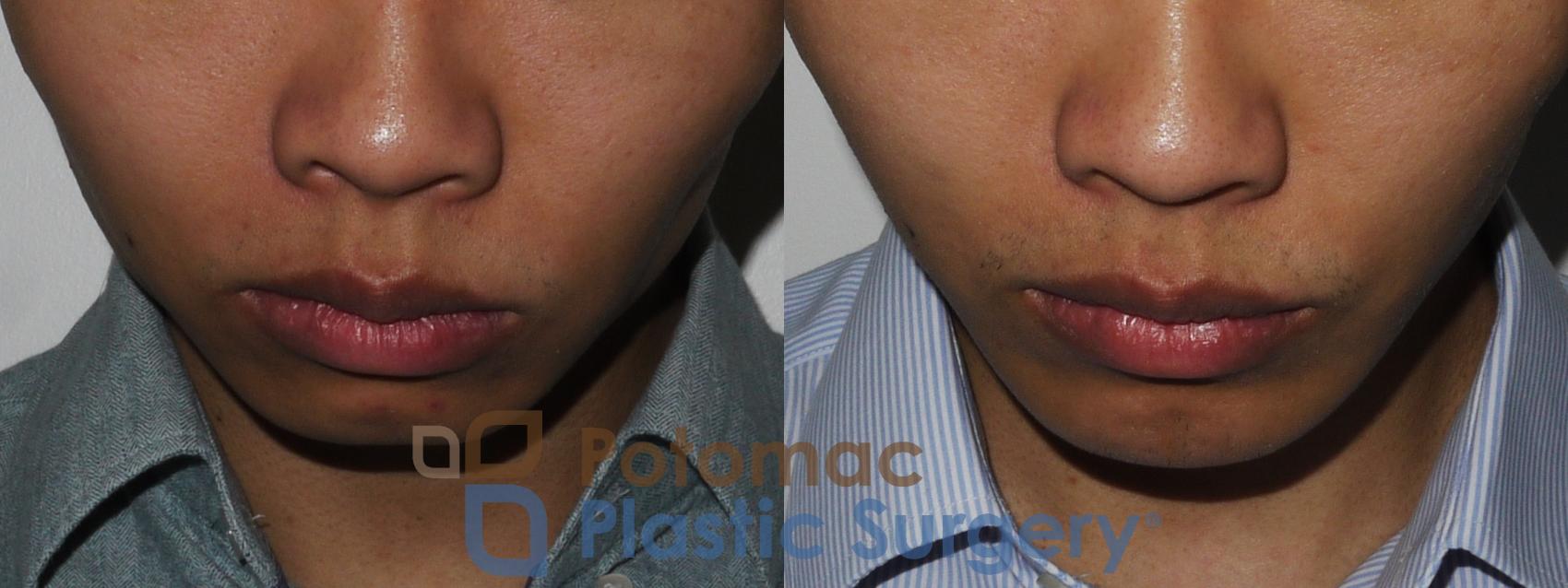 Before & After Chin Augmentation Case 187 Above View in Washington DC & Arlington , DC