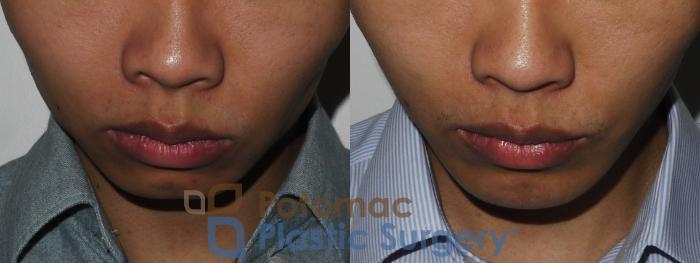 Before & After Chin Augmentation Case 187 Above View in Washington DC & Arlington , DC