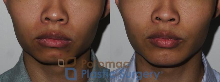 Before & After Chin Augmentation Case 187 Front View in Washington DC & Arlington , DC