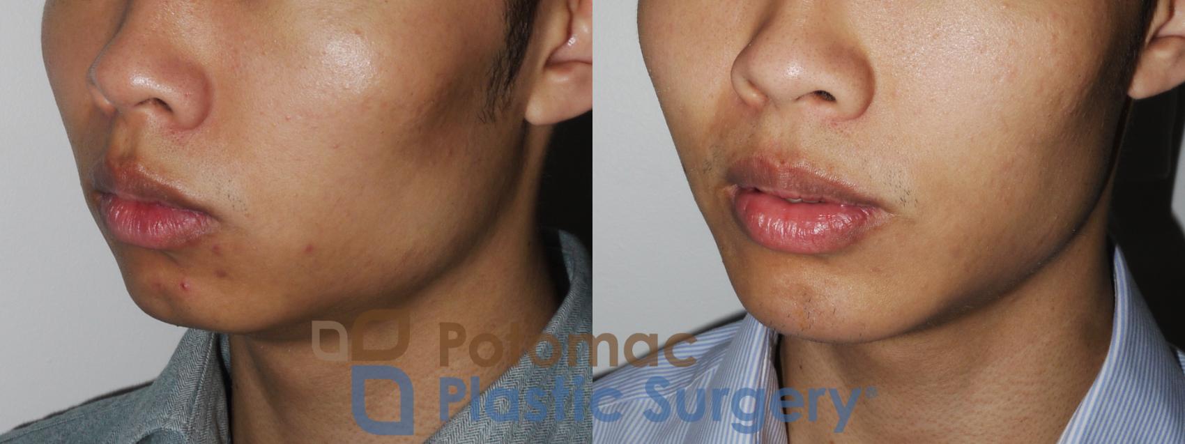 Before & After Chin Augmentation Case 187 Left Oblique View in Washington DC & Arlington , DC