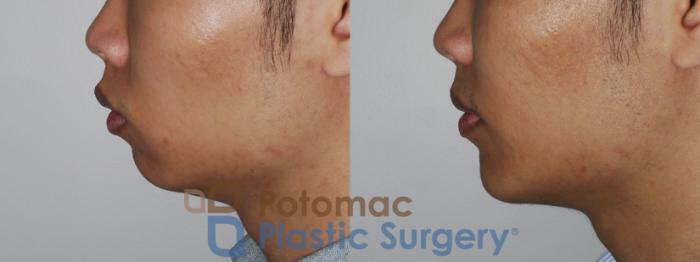 Before & After Chin Augmentation Case 187 Left Side View in Washington DC & Arlington , DC