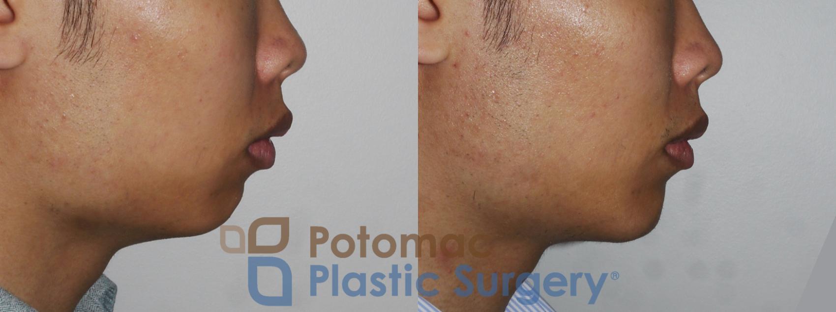 Before & After Chin Augmentation Case 187 Right Side View in Washington DC & Arlington , DC
