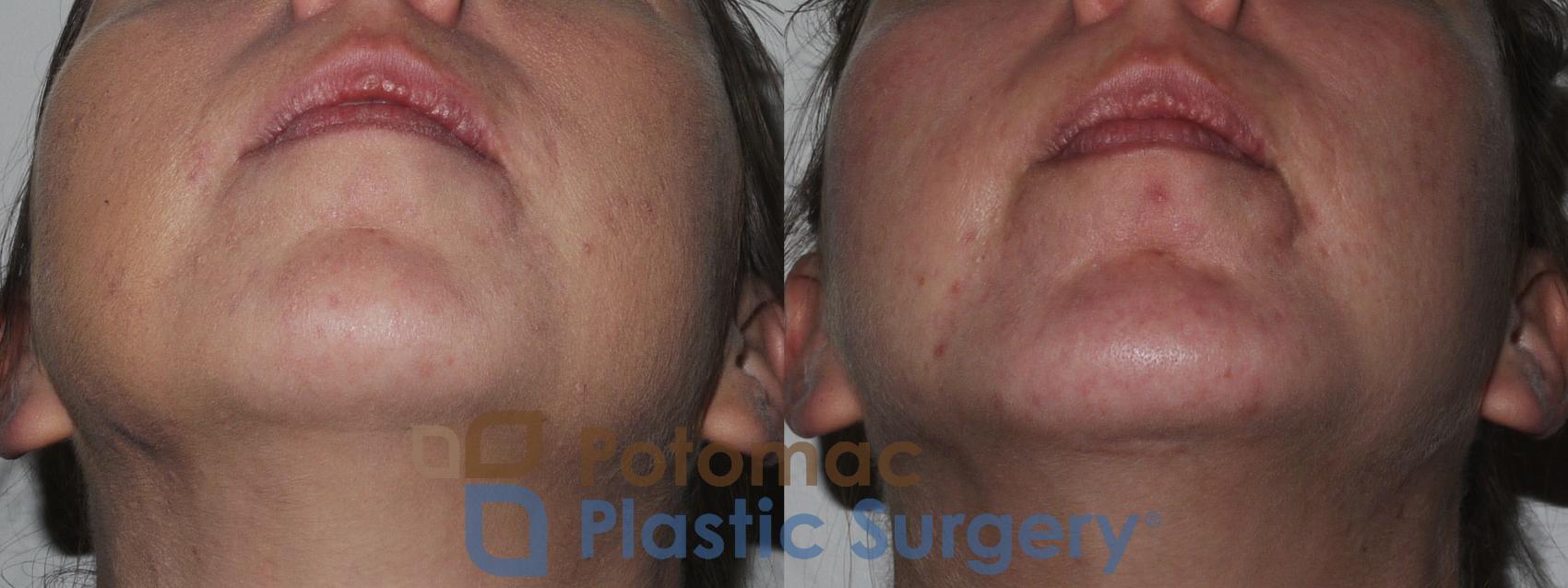 Before & After Chin Augmentation Case 201 Below View in Washington, DC